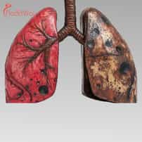 Alternative Cancer Treatments for Lung Cancer in Tijuana: Immunotherapy Leading the Way